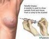 biopsy treatment